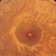 Autosomal Dominant Müller Cell Dystrophy, OD close-up Autosomal Dominant Müller Cell Dystrophy, OD close-up